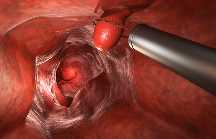 大腸ポリープの日帰り手術にも対応